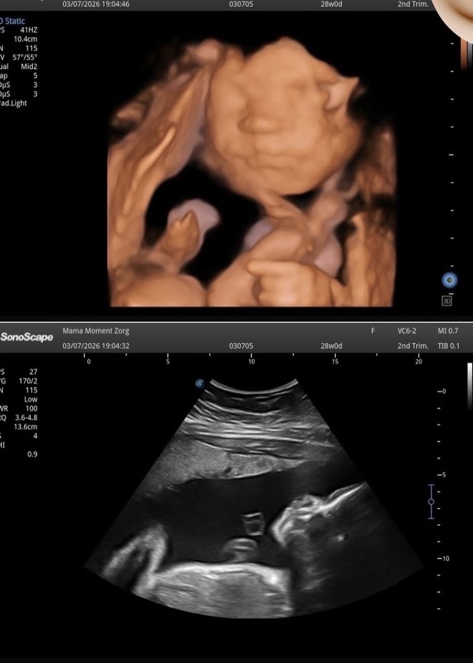 3D en 2D echobeeld van een baby van 28 weken, gemaakt bij Mama Moment Zorg